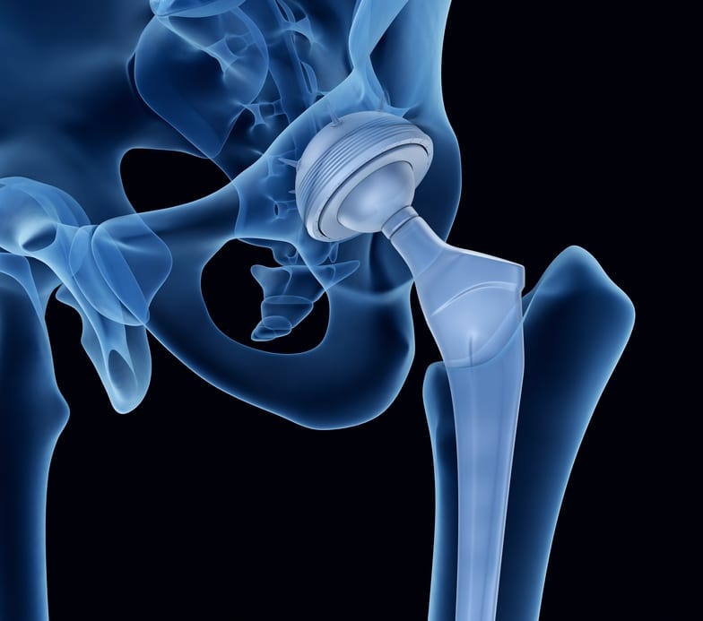 Understanding The Anterior Approach To Hip Replacement Valuehealth Muve